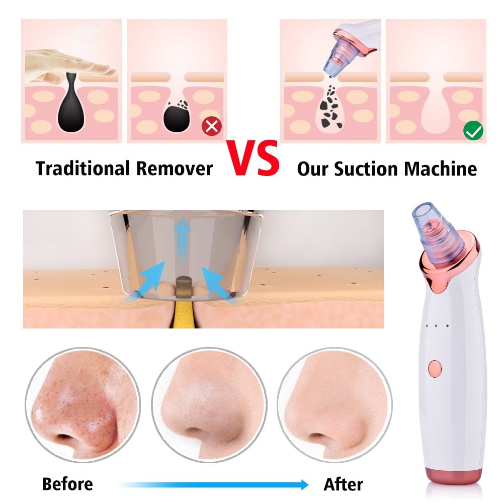 Electric Blackhead Suction Remover with Multi-Level Settings